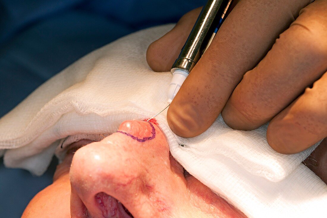 Basal cell carcinoma surgery