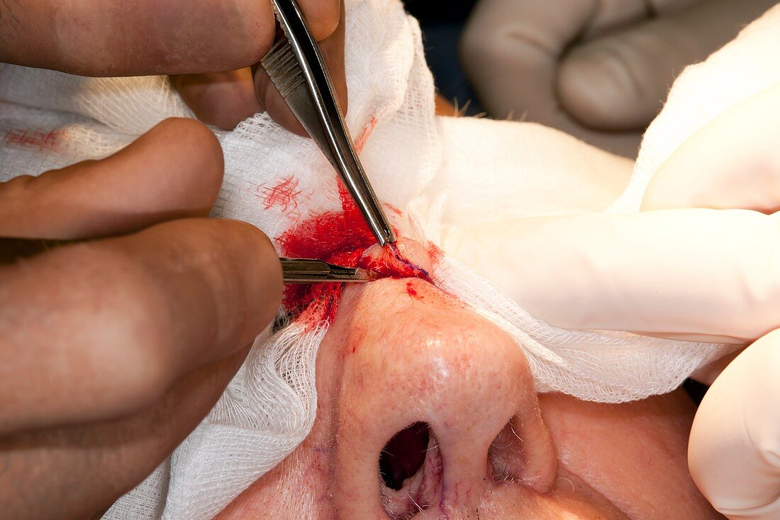 Basal cell carcinoma surgery