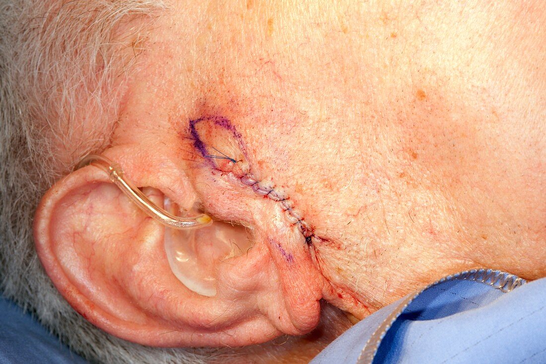 Basal cell carcinoma surgery