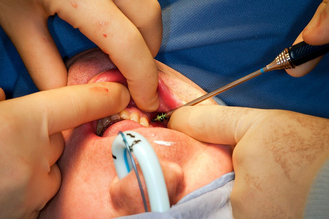 Jaw bone surgery