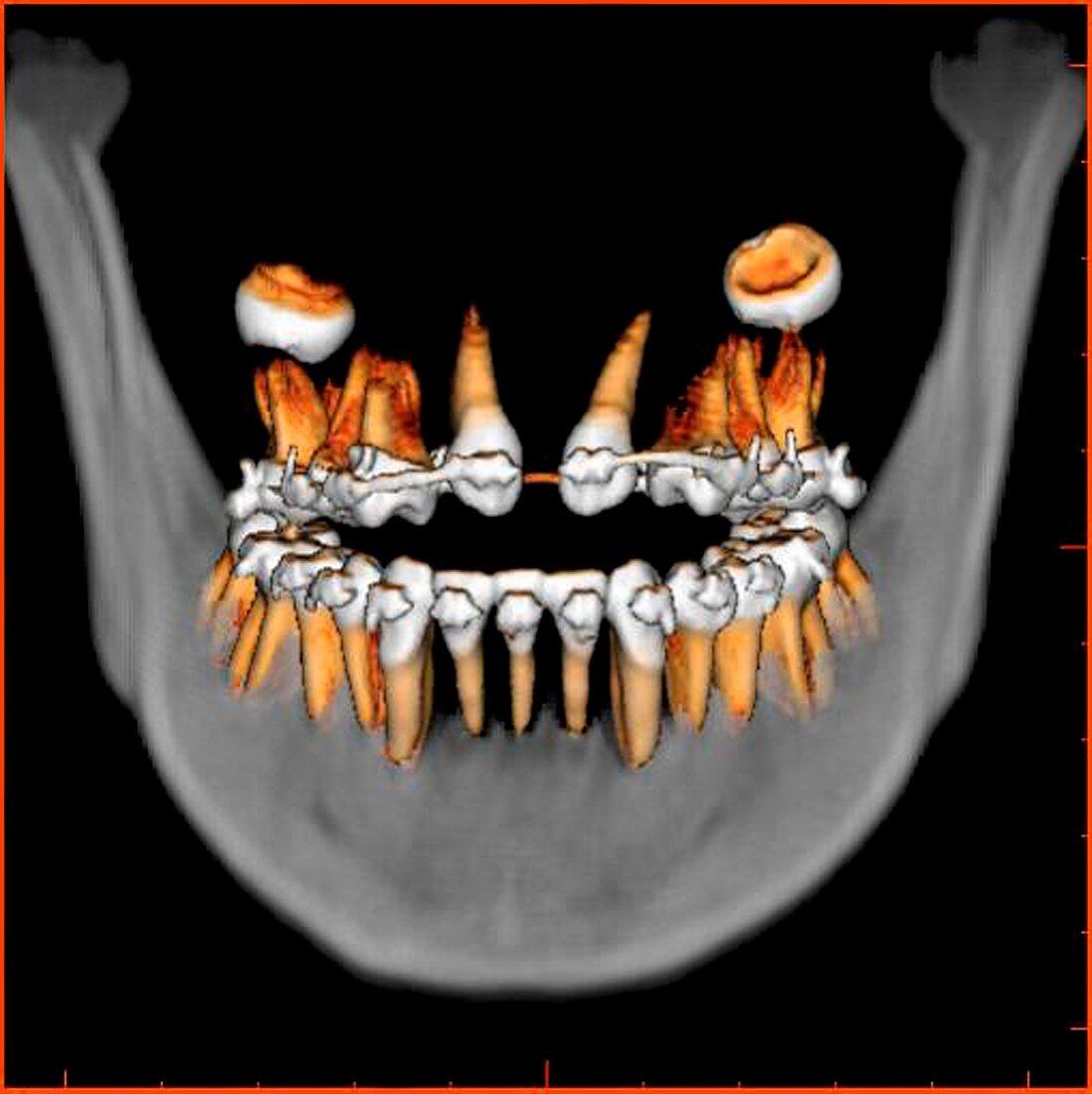 Teeth,3D CT scan