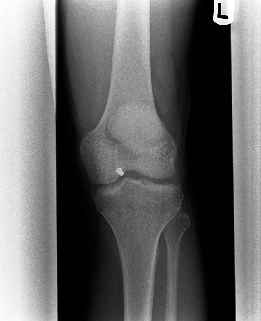 Firearm injury,X-ray