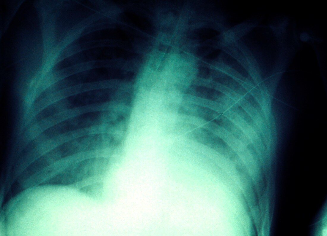 Pneumonic plague,X-ray
