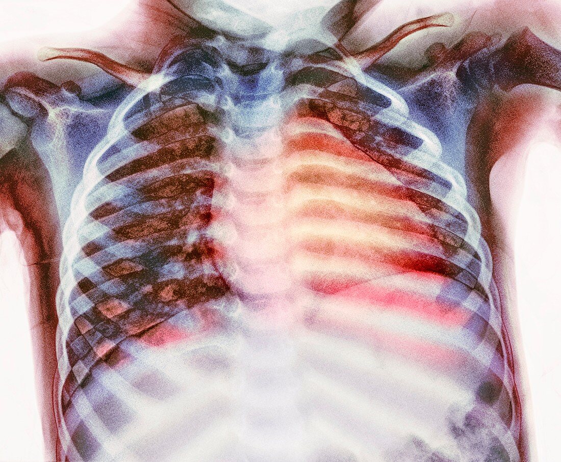 Healthy chest X-ray of a young child