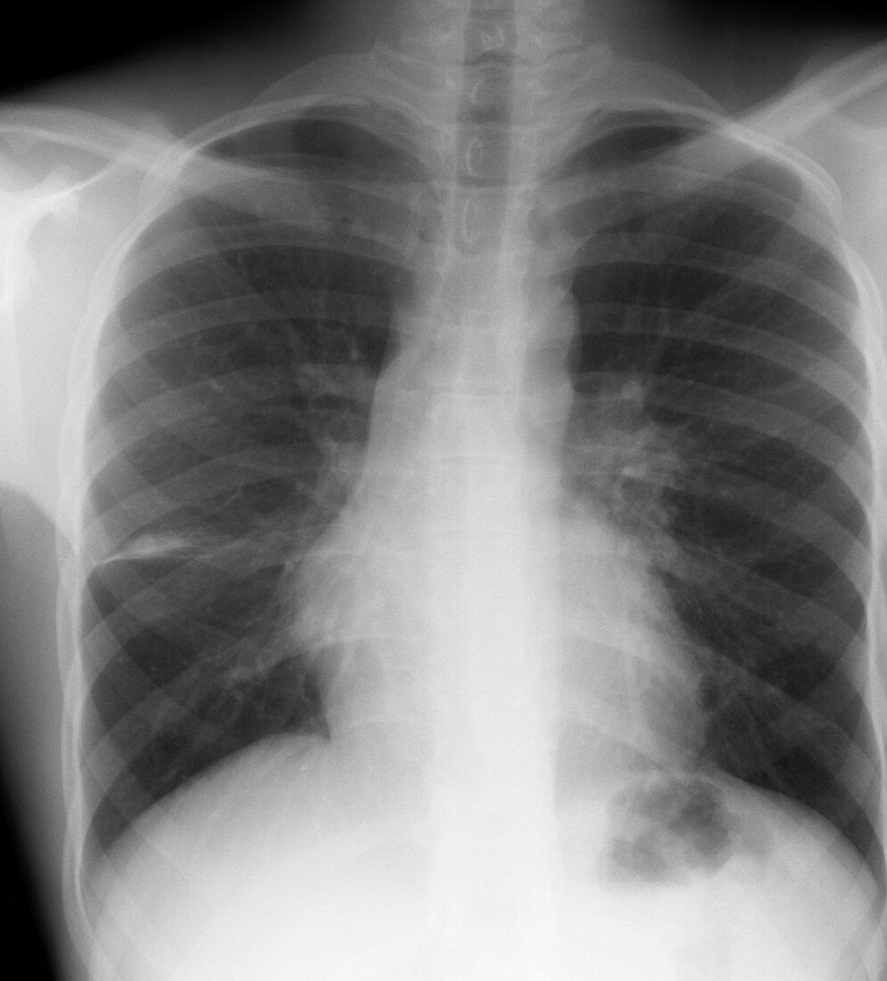 Tuberculosis lymphadenopathy,X-ray