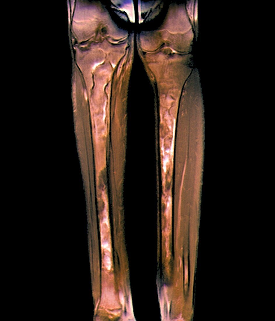Osteomyelitis in lower legs,MRI scan