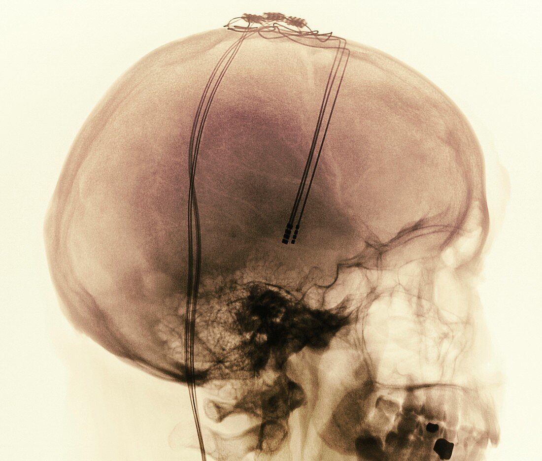Deep brain stimulation electrodes,X-ray