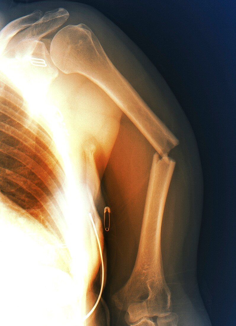 Broken arm bone,X-ray
