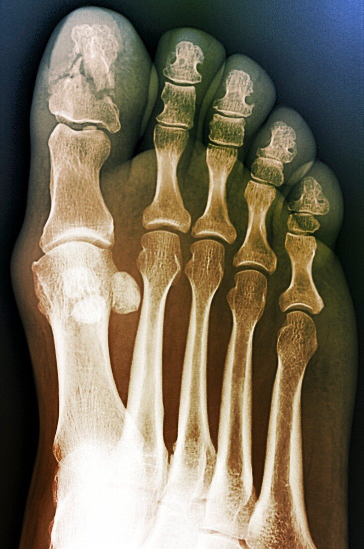 Broken toe bone,X-ray