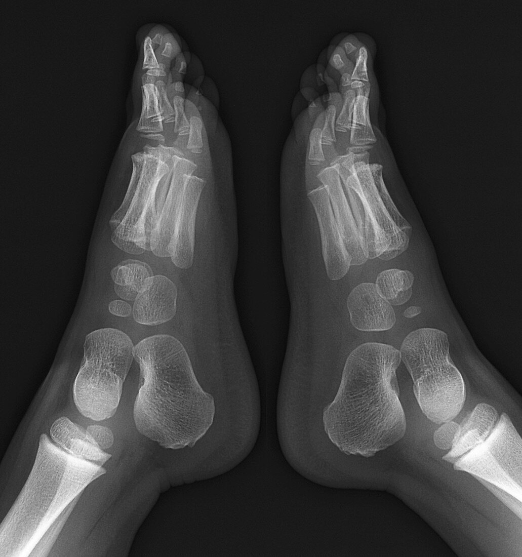 Childhood bone development,feet X-ray
