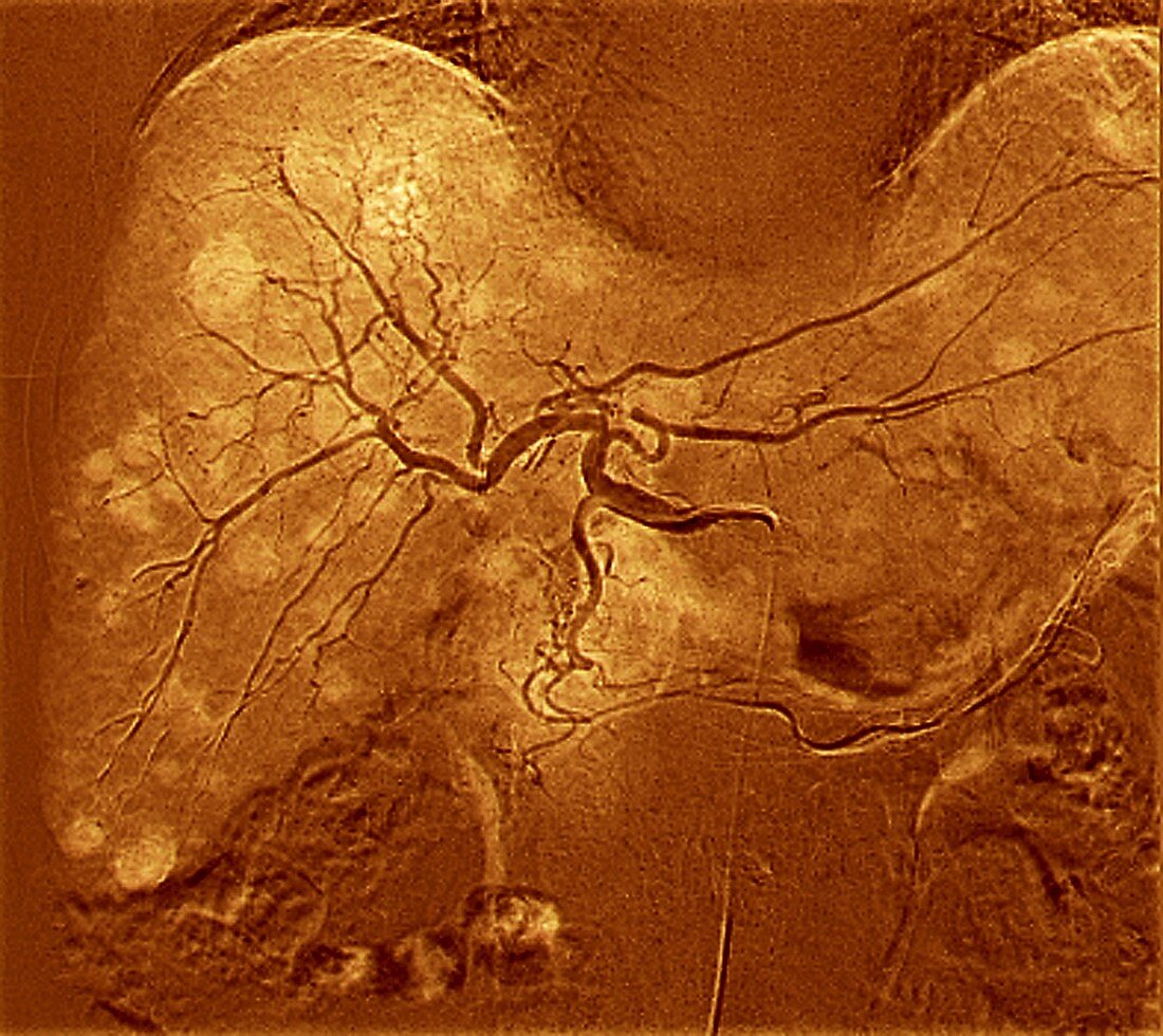 Secondary liver cancer,3D angiogram