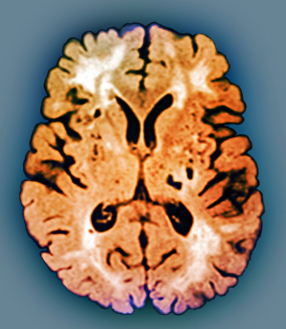 CADASIL syndrome,MRI scan