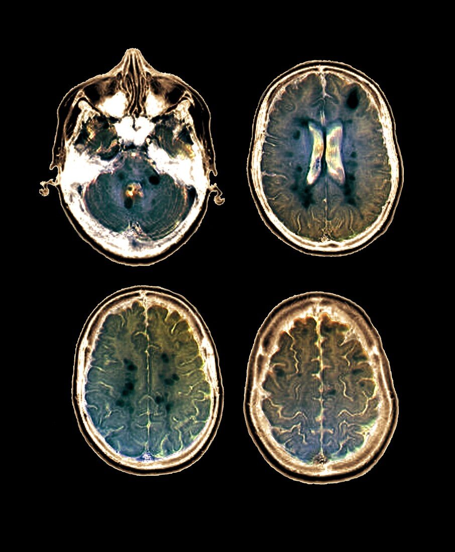 Pyramidal brain syndrome,MRI scans