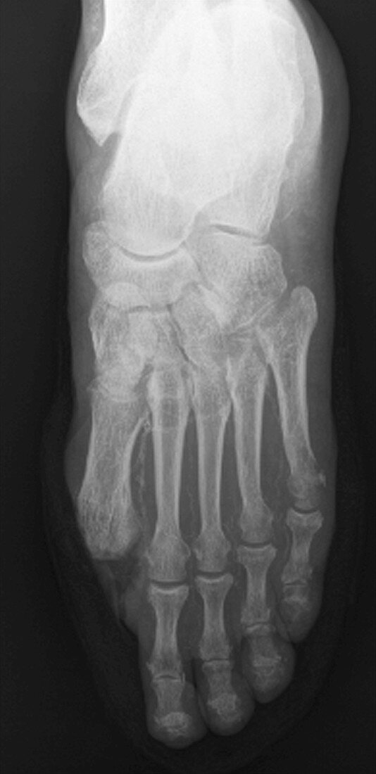 Toe amputation in diabetes,X-ray