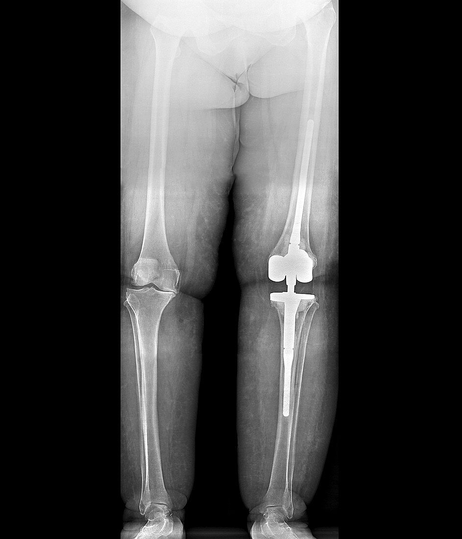 Prosthetic knee and obesity,X-ray