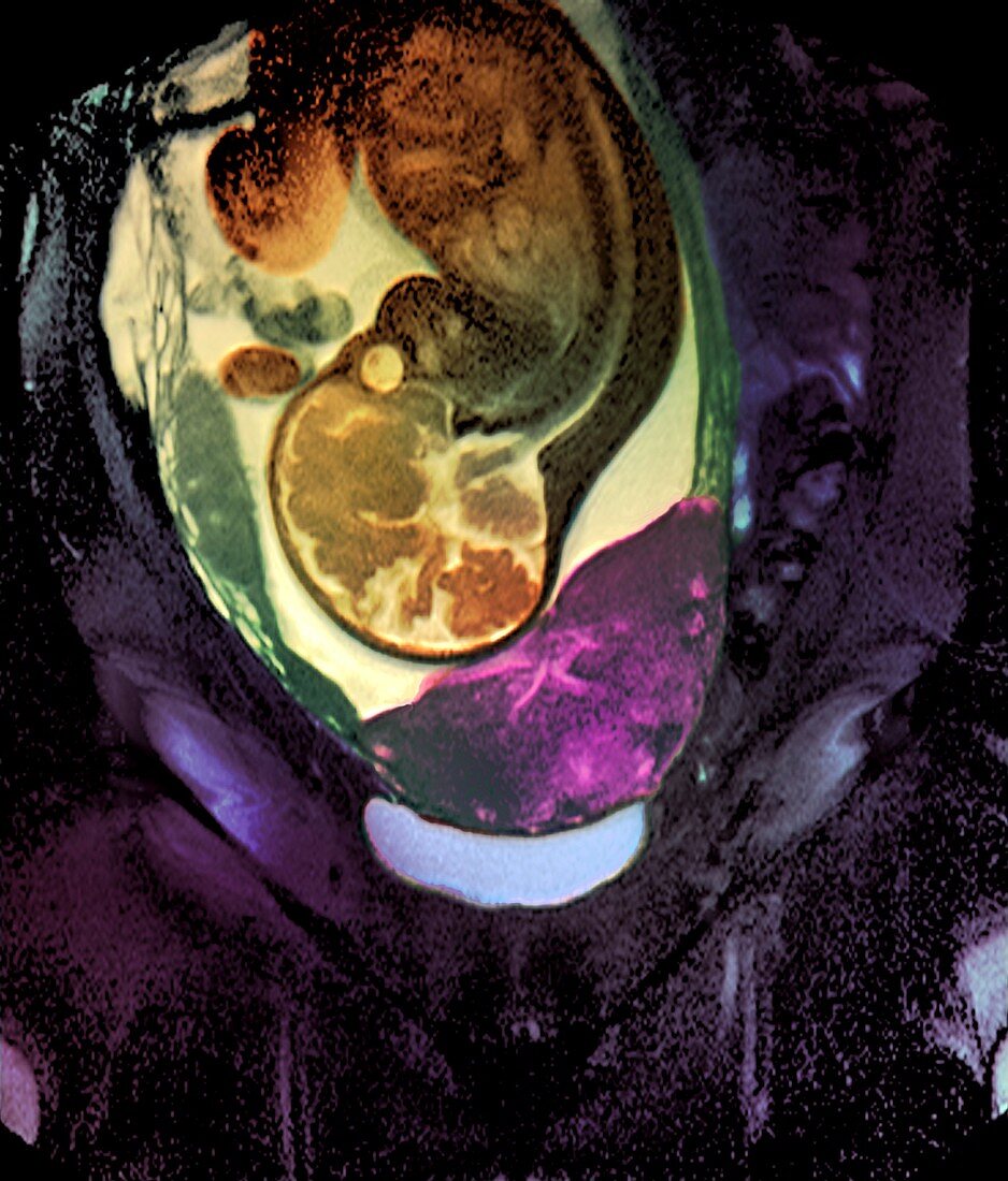 Placenta previa,MRI scan