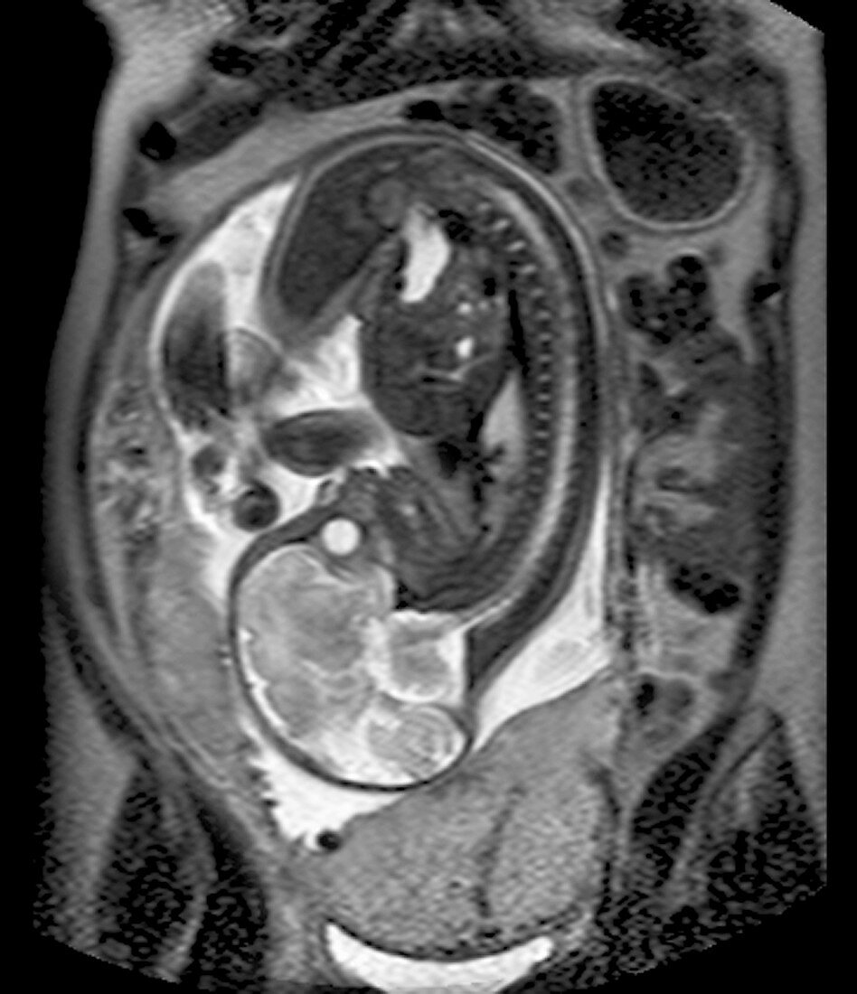 Placenta previa,MRI scan