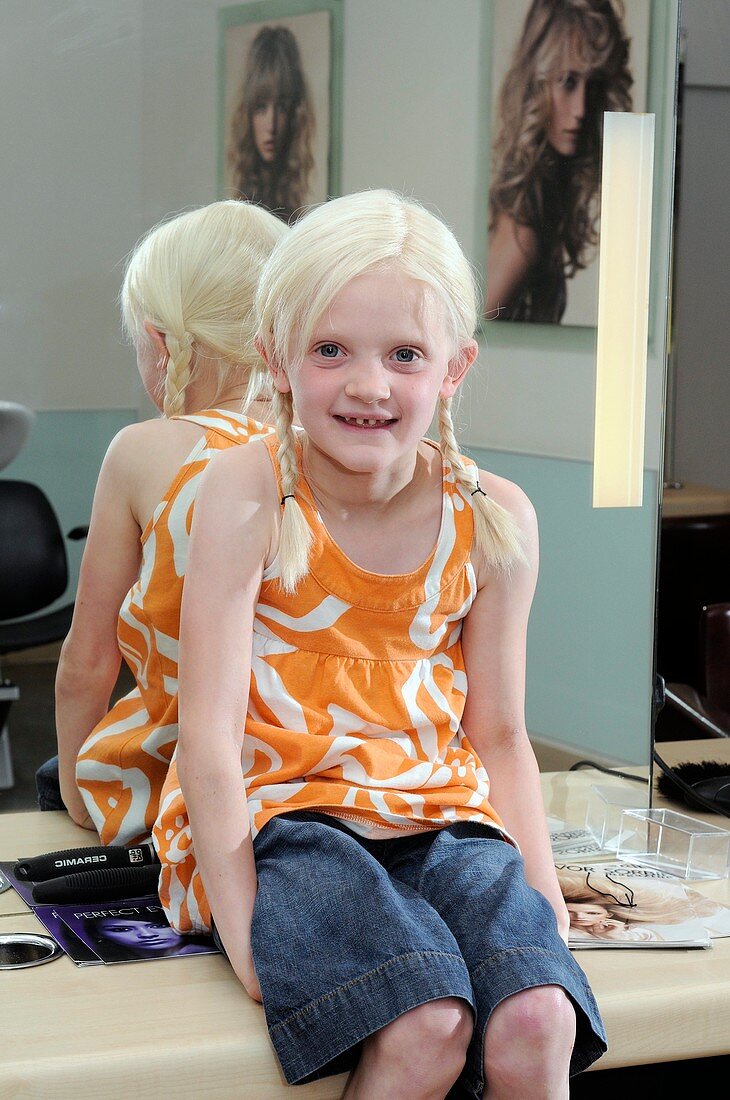 Girl with ectodermal dysplasia with wig