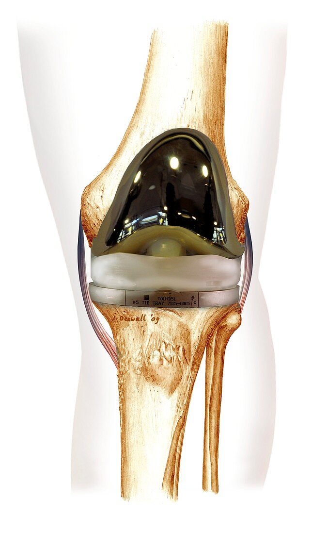 Total knee replacement,artwork