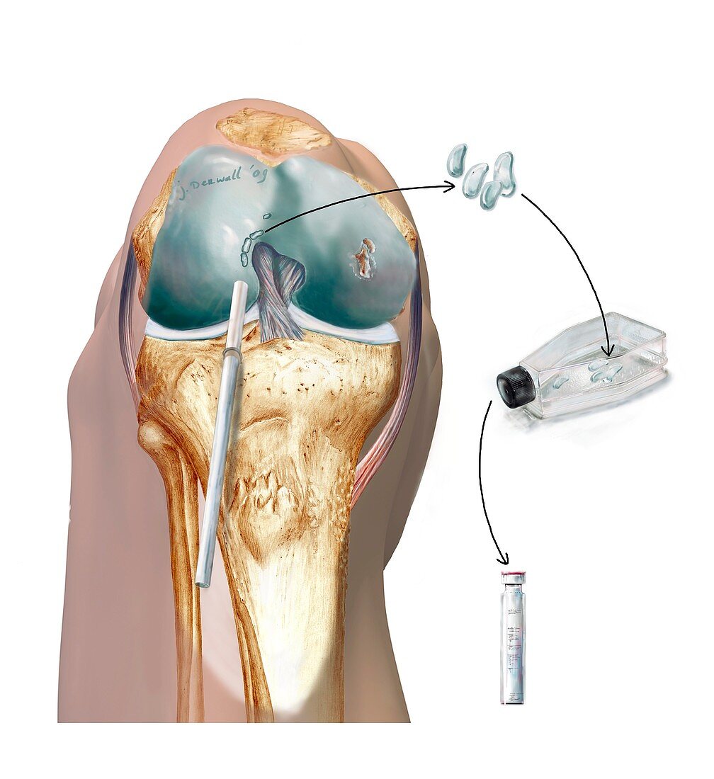 Knee cartilage reconstruction,artwork