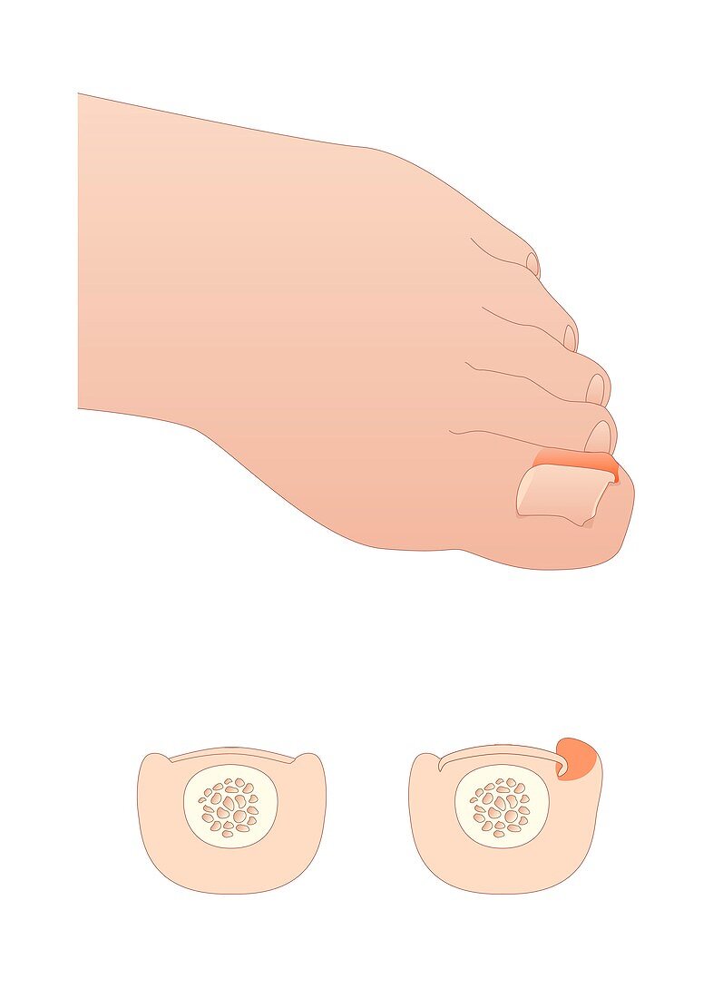 Ingrowing toenail,artwork