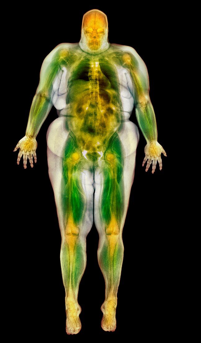 Obese woman,MRI scan