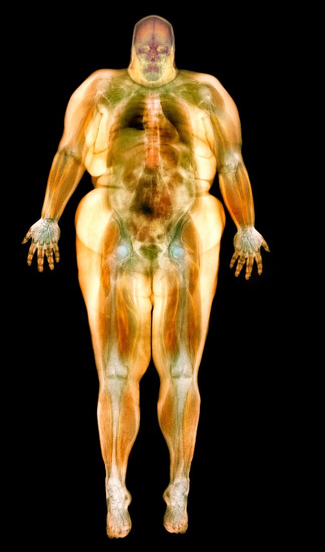 Obese woman,MRI scan