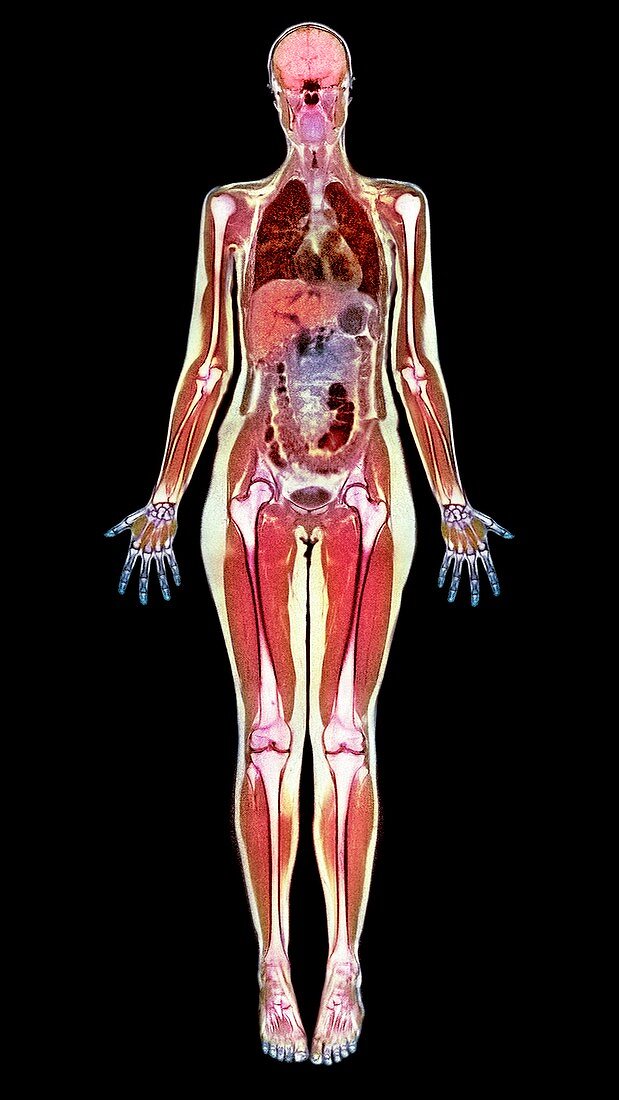 Thin woman,MRI scan