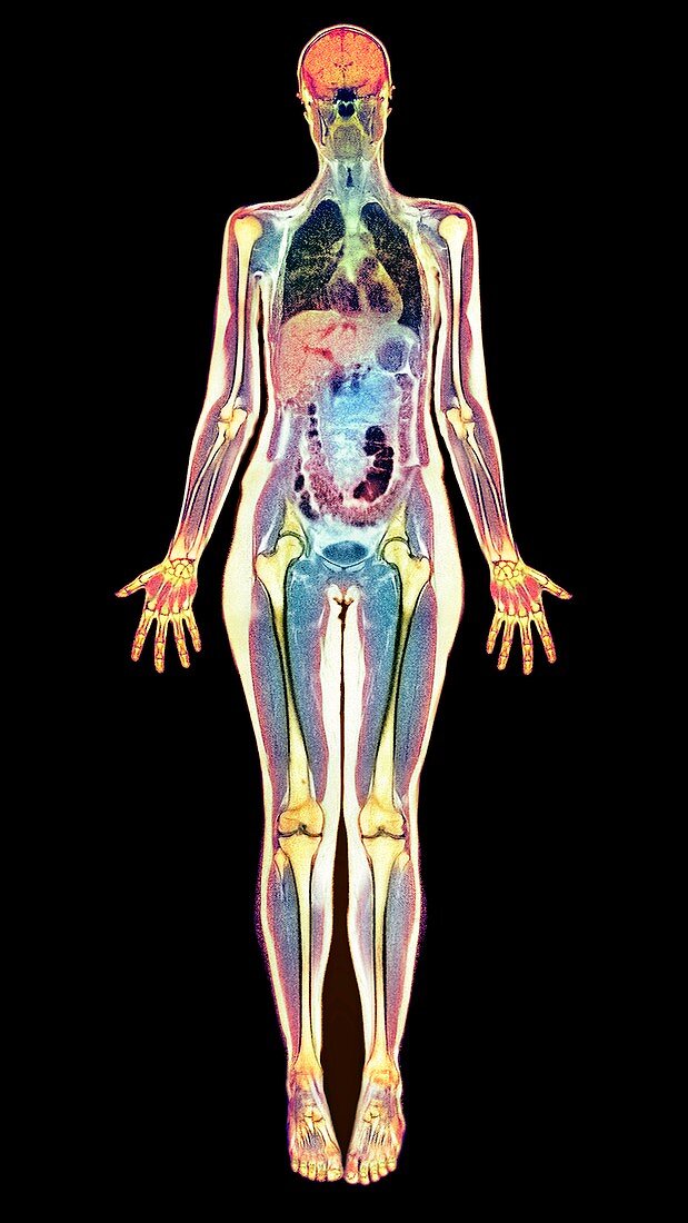 Thin woman,MRI scan