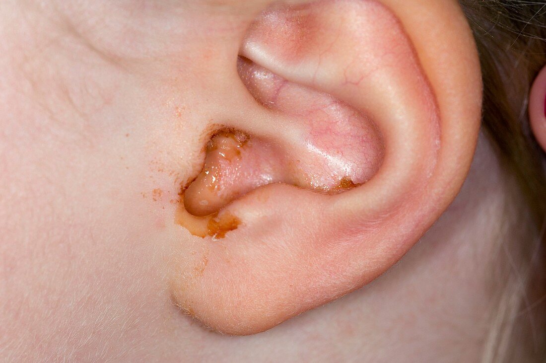 Middle ear infection (otitis media)