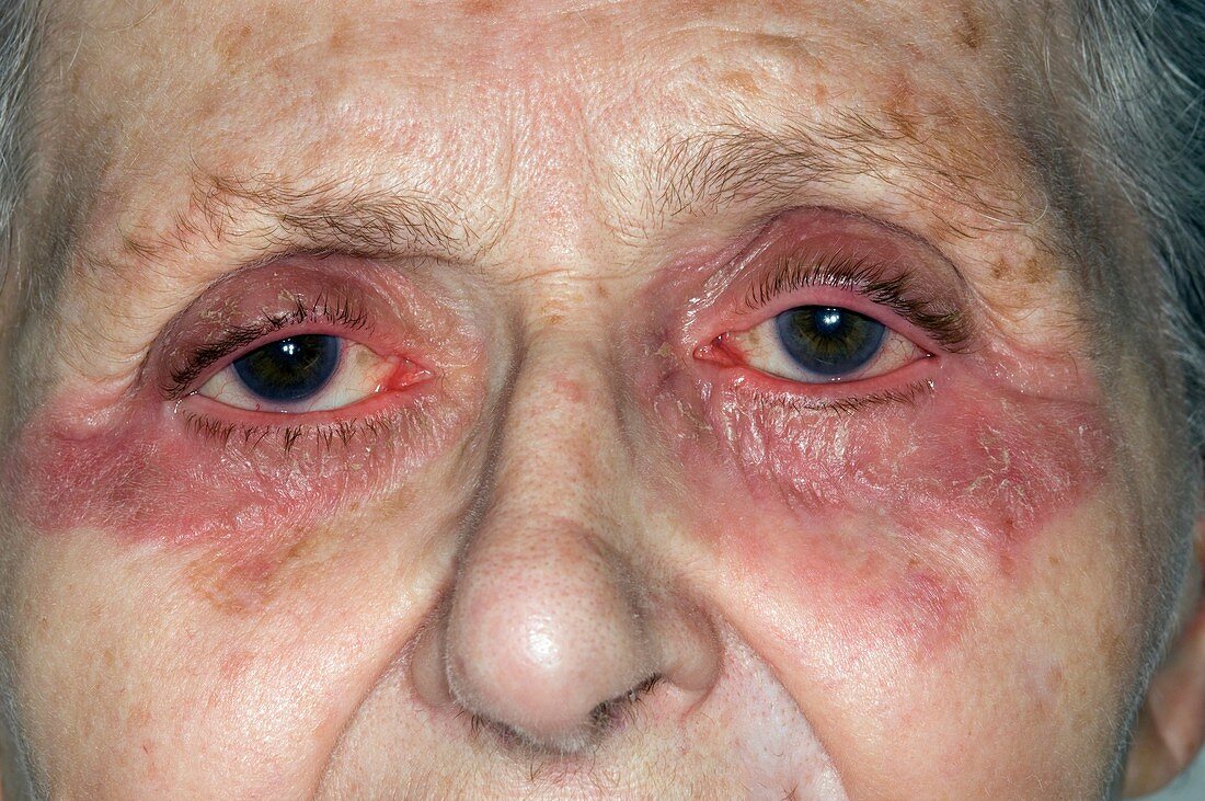 Peri-orbital eczema around the eyes