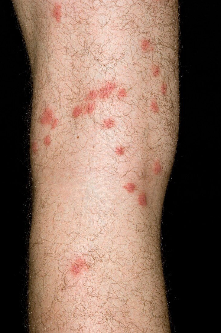 Allergy to insect bites on the leg