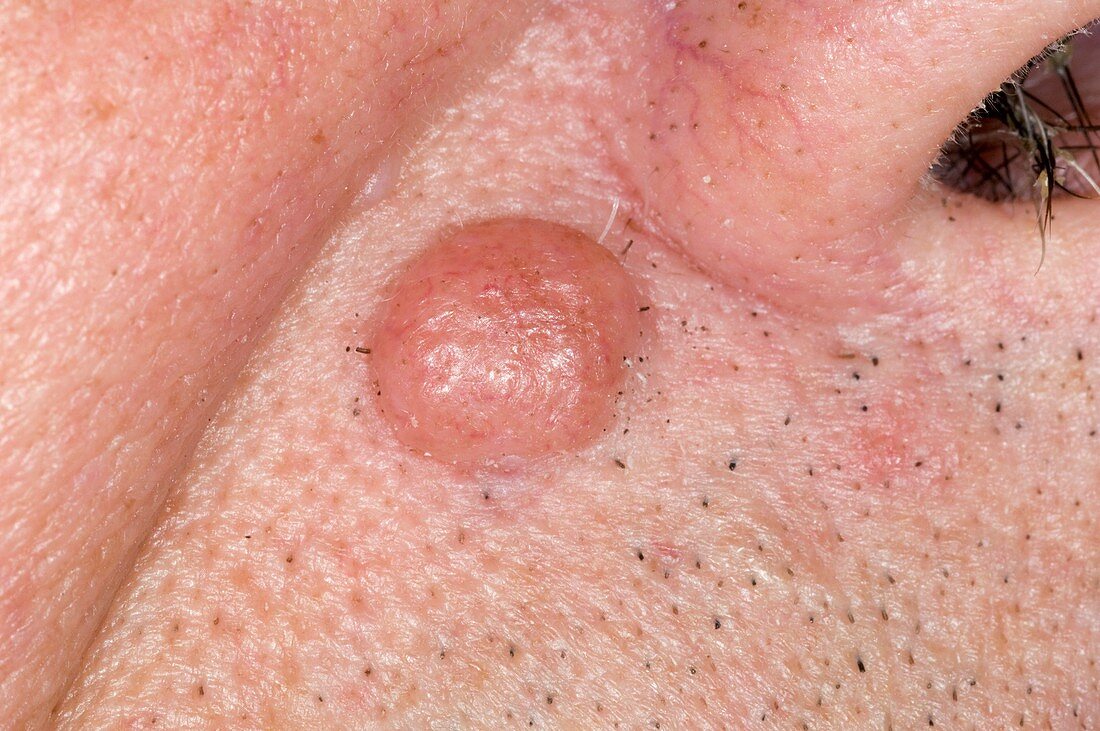 Pigmented mole (naevus)