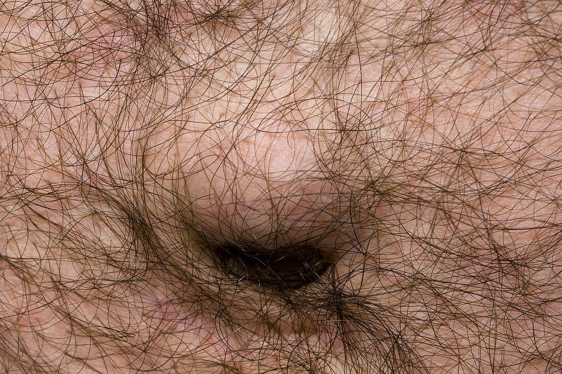 Para-umbilical hernia