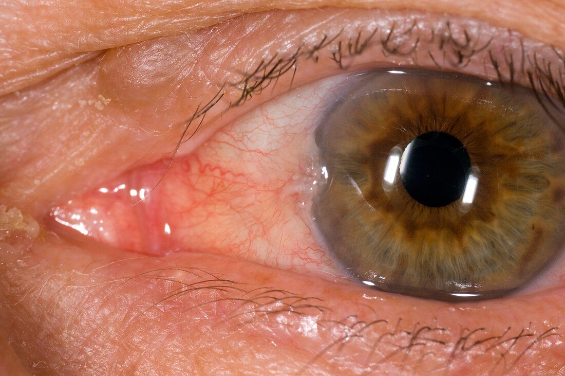 Pterygium of the eye