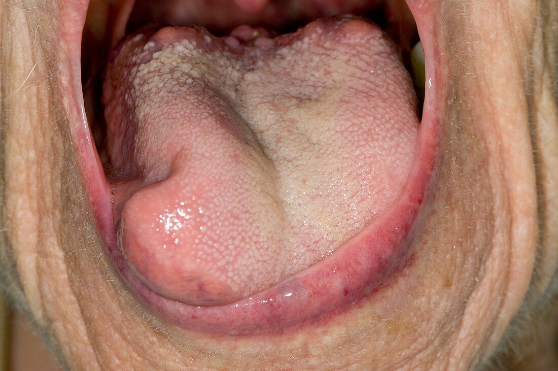 Tongue self-mutilation