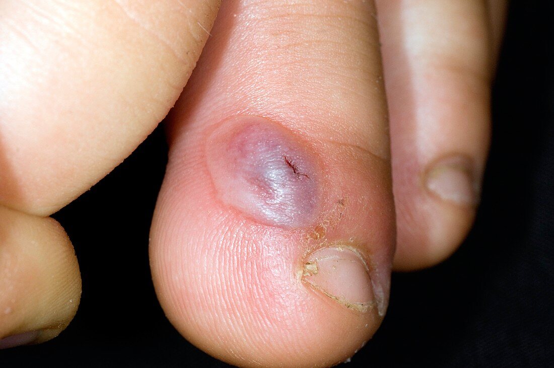 Wasp sting on the toe