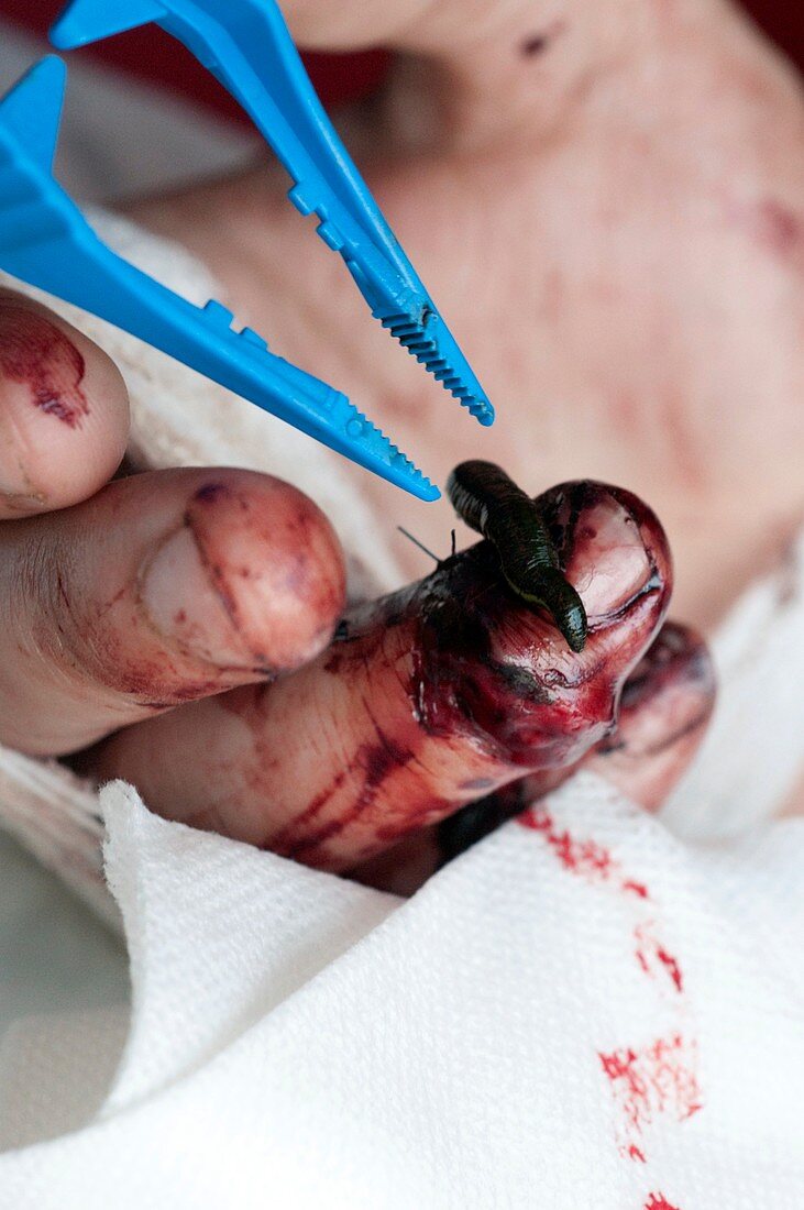 Medicinal leech on patient's finger