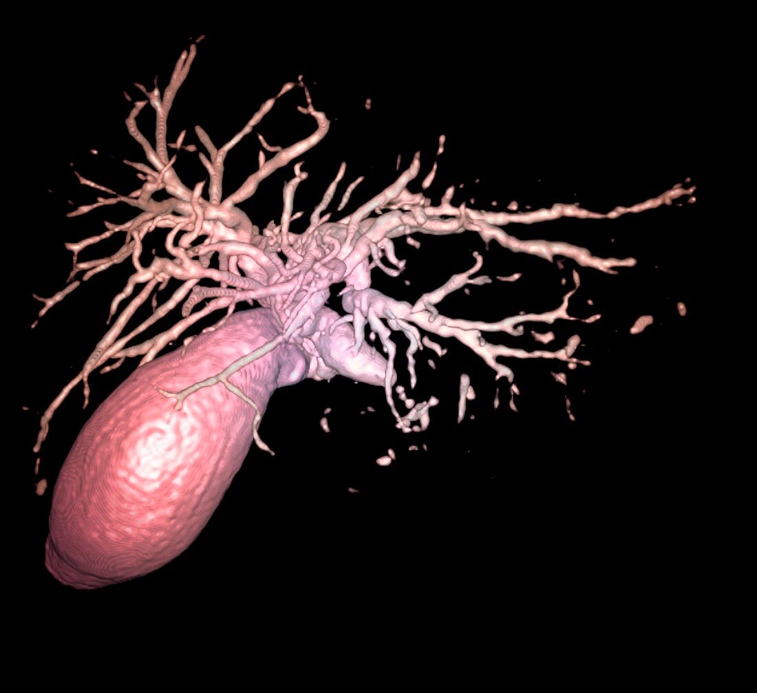 Gallbladder and biliary tree,3D MRI