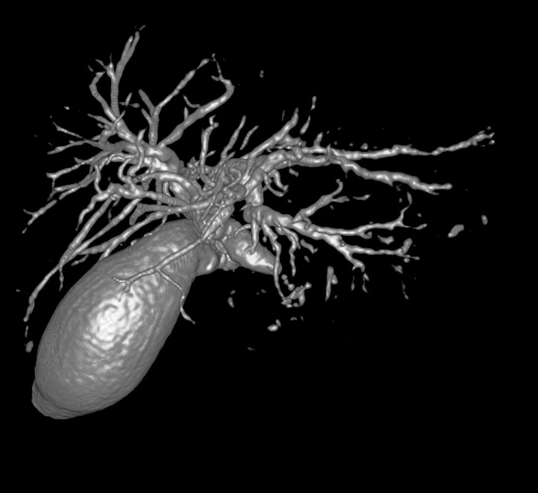 Gallbladder and biliary tree,3D MRI