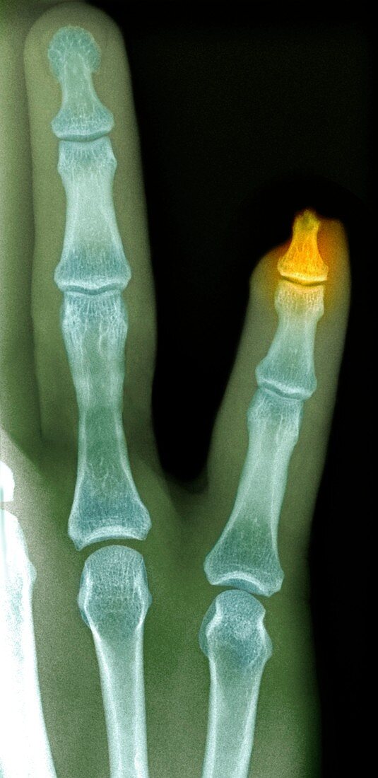Amputated fingertip,X-ray