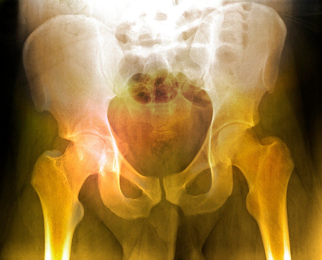 Fractured pelvis,X-ray