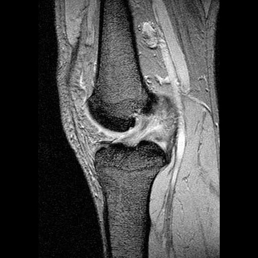 Anterior cruciate ligament tear,CT scan Bild kaufen 11591339