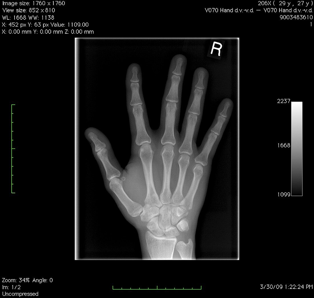 Normal hand,digital X-ray