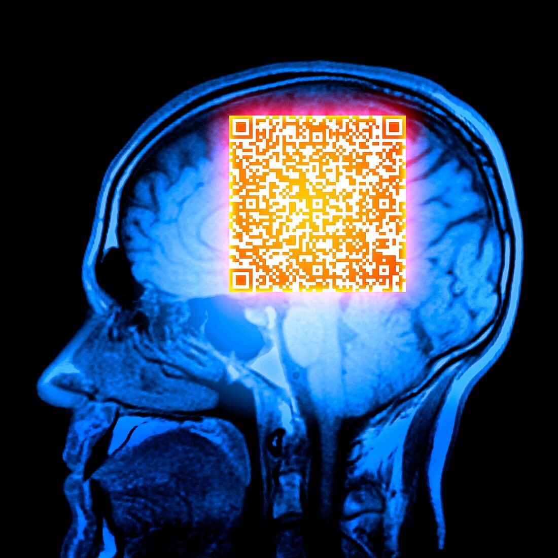 Brain MRI scan with Alzheimer's QR code