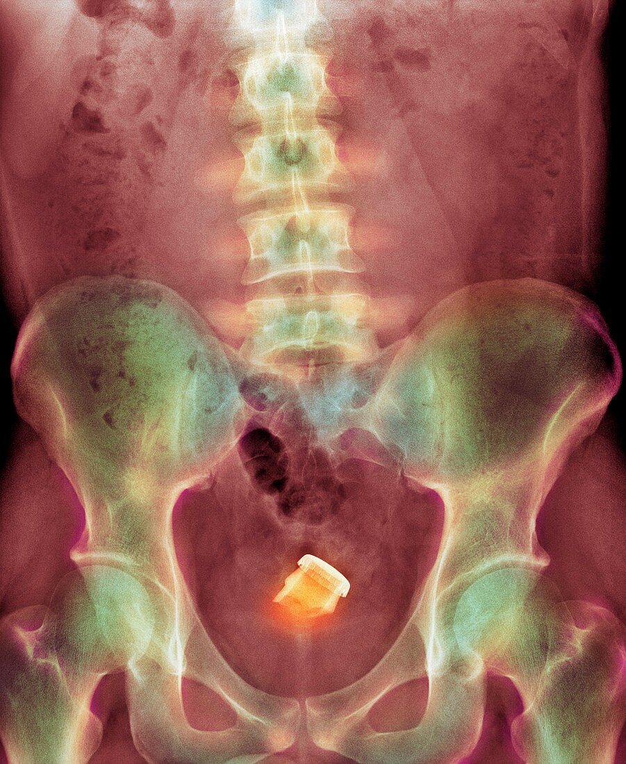 Drinks bottle in man's rectum,X-ray