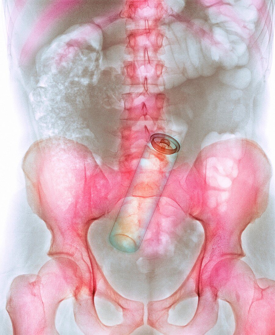 Deodorant can in man's rectum,X-ray