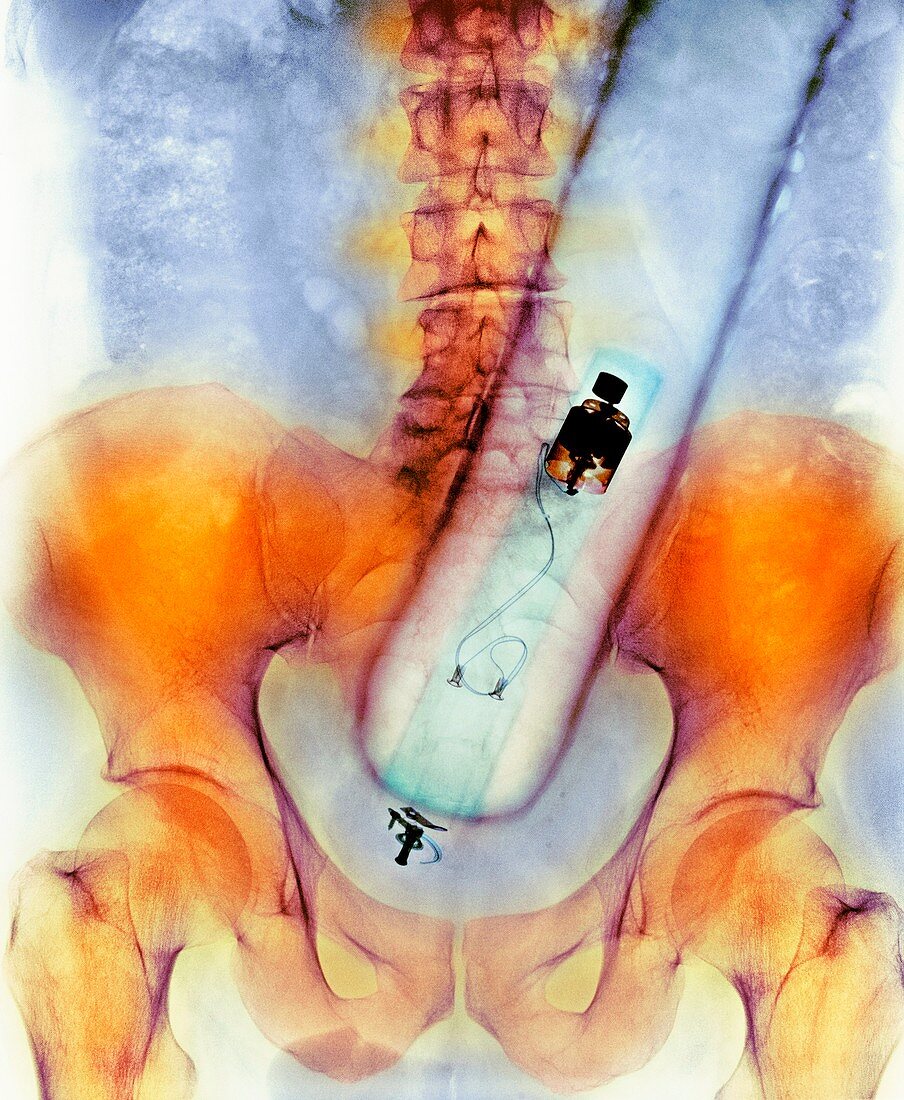 Vibrator in man's rectum,X-ray