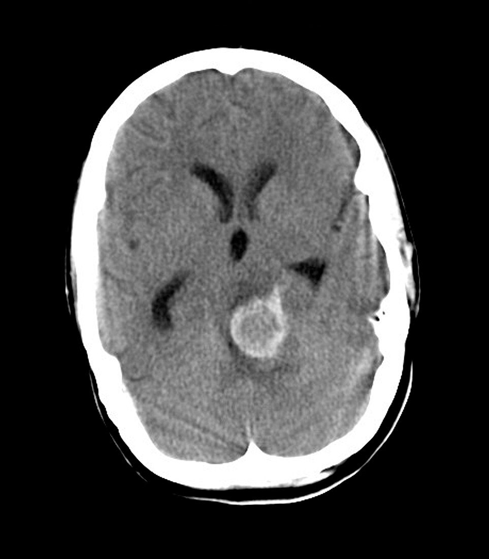 Berry aneurysm,MRI scan