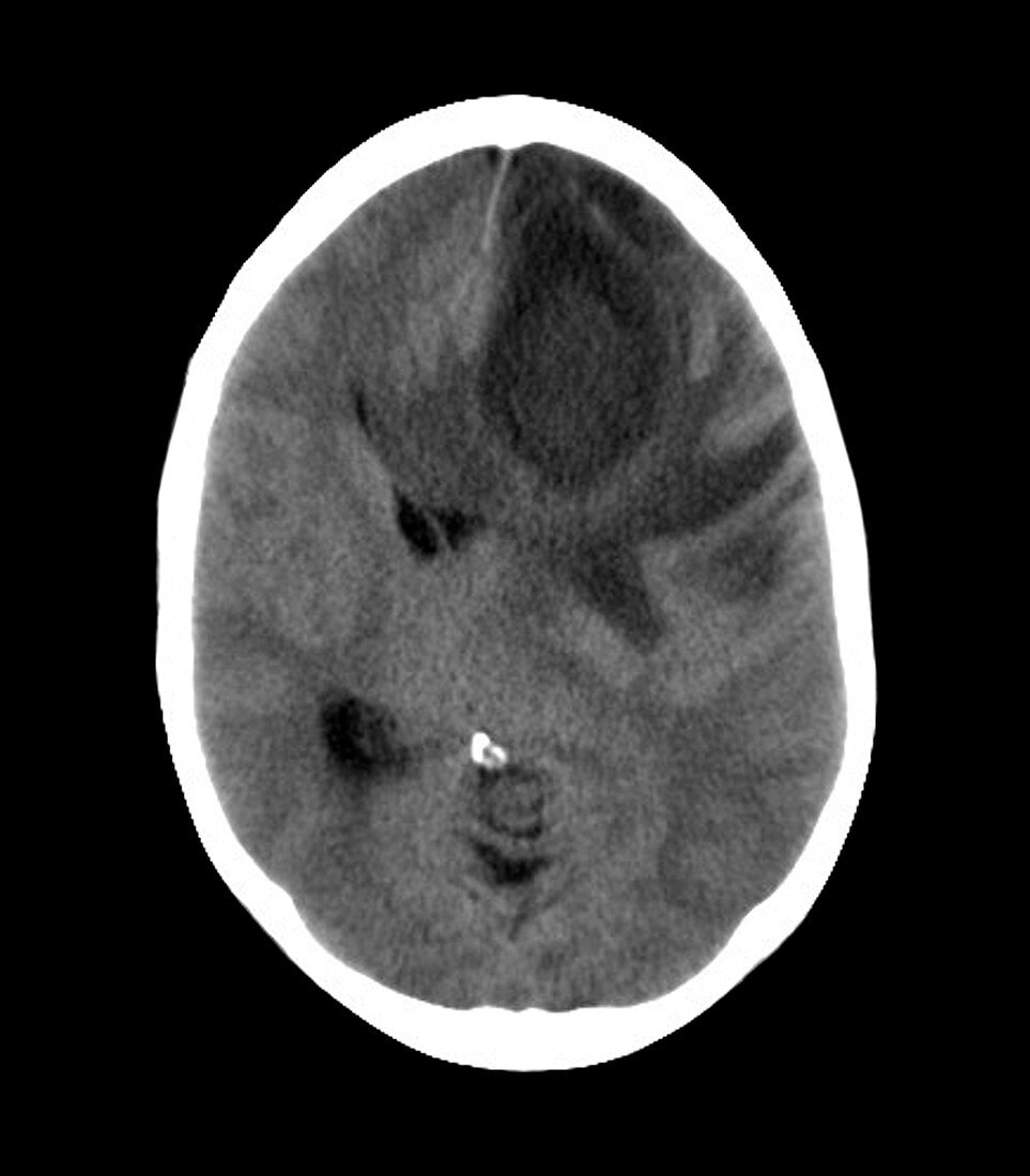 Brain abscess,MRI scan